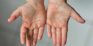 Terancam! Flu Singapura Meningkat, Dinas Kesehatan Kota Yogyakarta Serukan Kewaspadaan! Sumber Hermina.